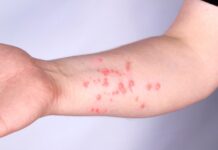 SC reforça orientações sobre Mpox e afirma que não há motivo para alarme